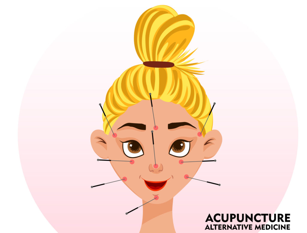 Bell's Palsy Acupuncture