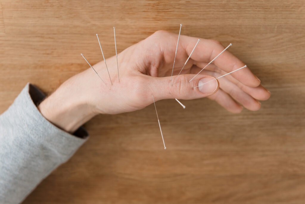 acupuncture for pinched nerve