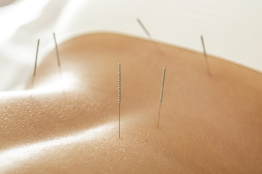 acupuncture or massage for back pain?