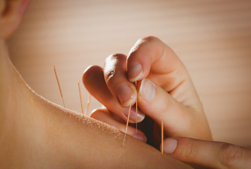 Acupuncture vs massage